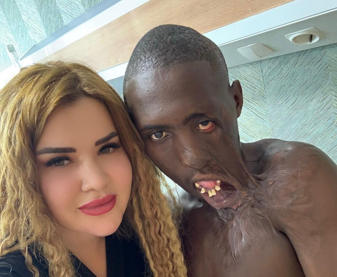Acı verici bekleme: Yüz ve boyunda ağır yanıklar vardı! Papaz Ugandali 10 yıl sonra Türkiye'de tedavi edildi ... 5