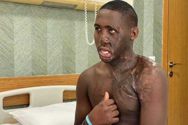 Acılı bekleyiş: Yüzü ve boynunda ağır yanıklar vardı! Ugandalı çoban, 10 yıl sonra Türkiye’de tedavi edildi…
