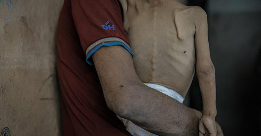 Gazze’de 127 Filistinli açlıktan hayatını kaybetti